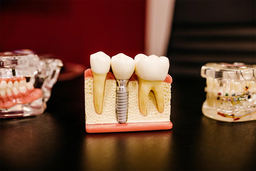 The Transformative Power of Dental Implants: Reconstructing Smiles and Lives