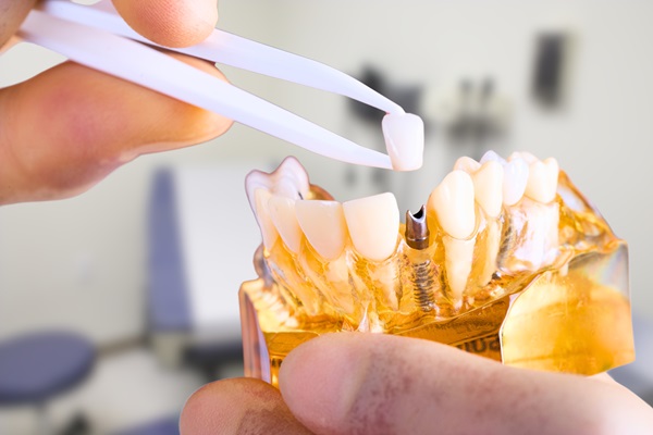 Simple Steps To Place Dental Implants