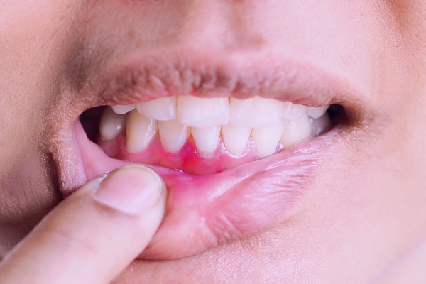 Common Signs Of Gum Disease